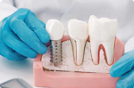 implantes dentales en Córdoba Capital
